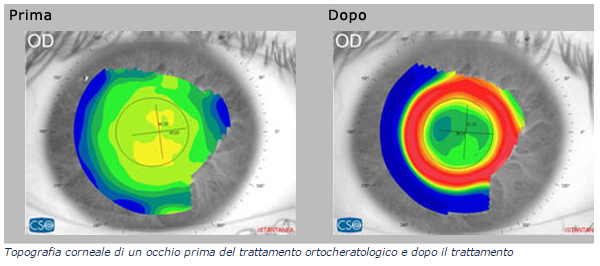 FireShot Capture 5 - Come funzionano le lenti ORTO-K