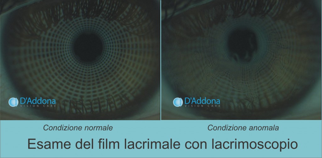 lacrimoscopio