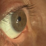 lente Minisclerale applicata su cornea sottoposta a trapianto corneale. Visus senza lac 1/10 con lac 10/10