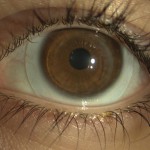 lente Minisclerale applicata su cornea sottoposta a trapianto corneale. Visus senza lac 3/10 con lac 12/10