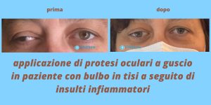 protesi ocualri